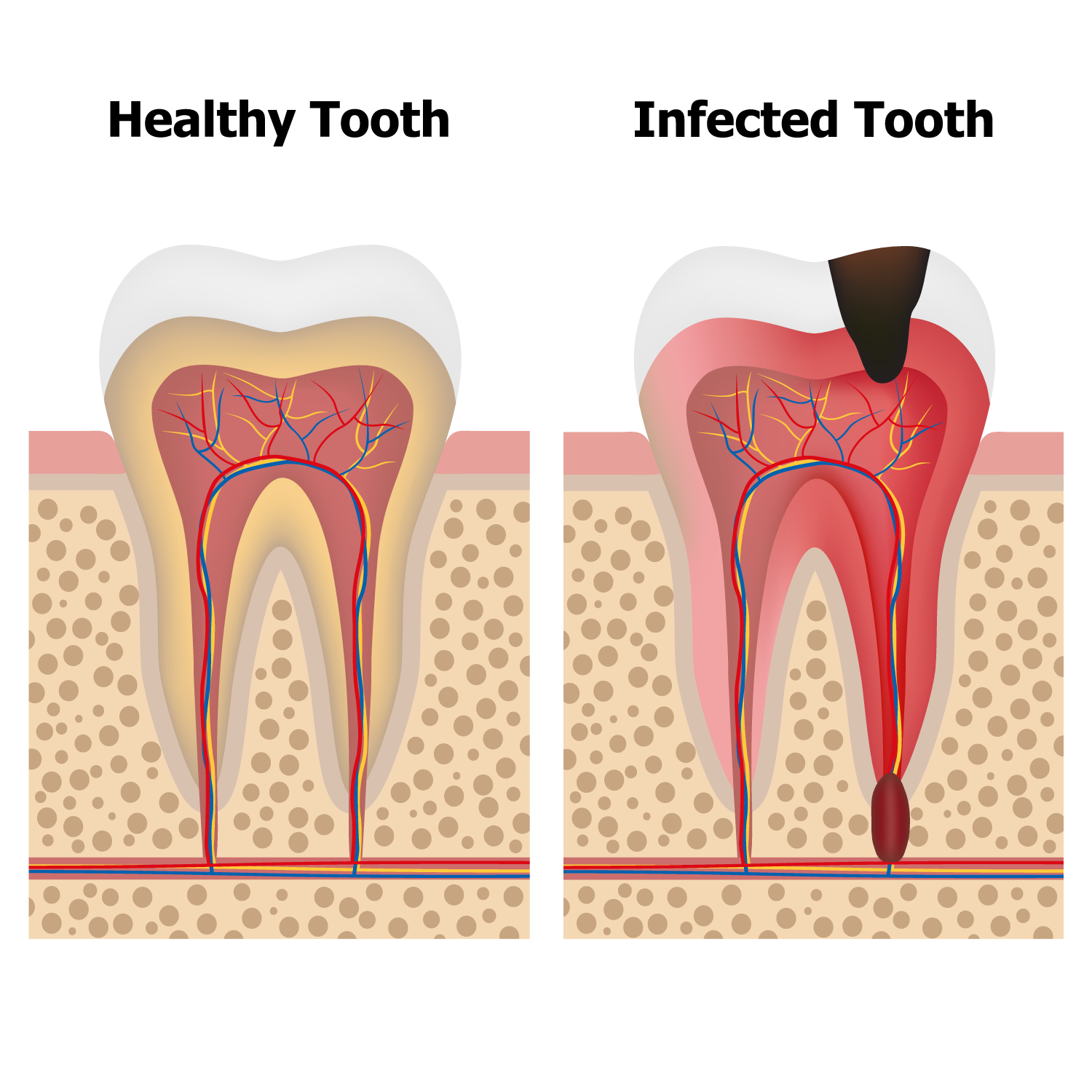 Root Canal Therapy In Wainwright Wainwright Dental Care